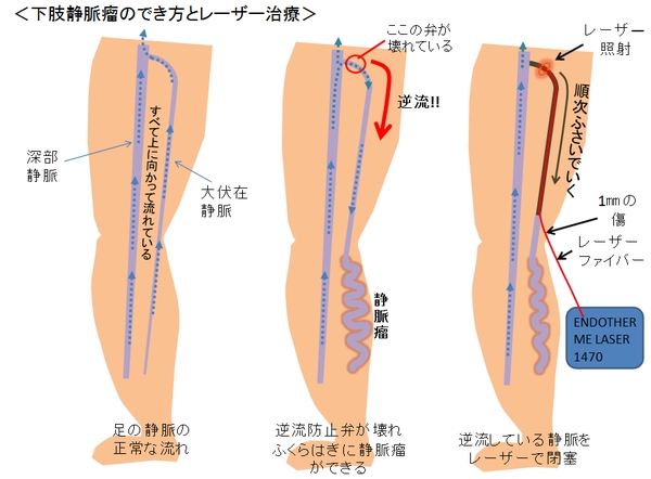 下肢静脈瘤に対する血管内治療 - 独立行政法人国立病院機構 大阪南医療